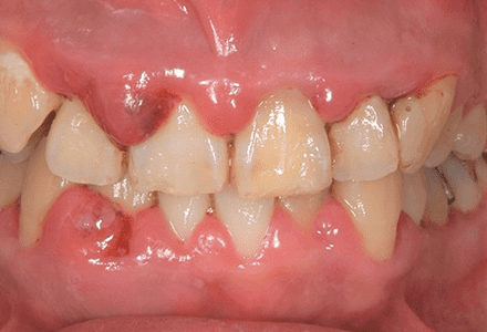 歯を失う恐れのある歯周病