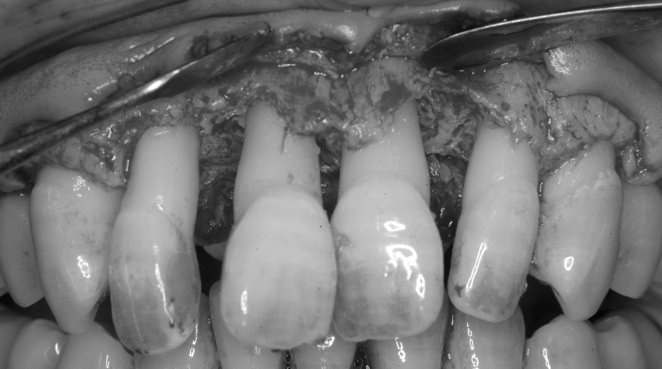 歯周組織再生誘導療法（上顎前歯部）