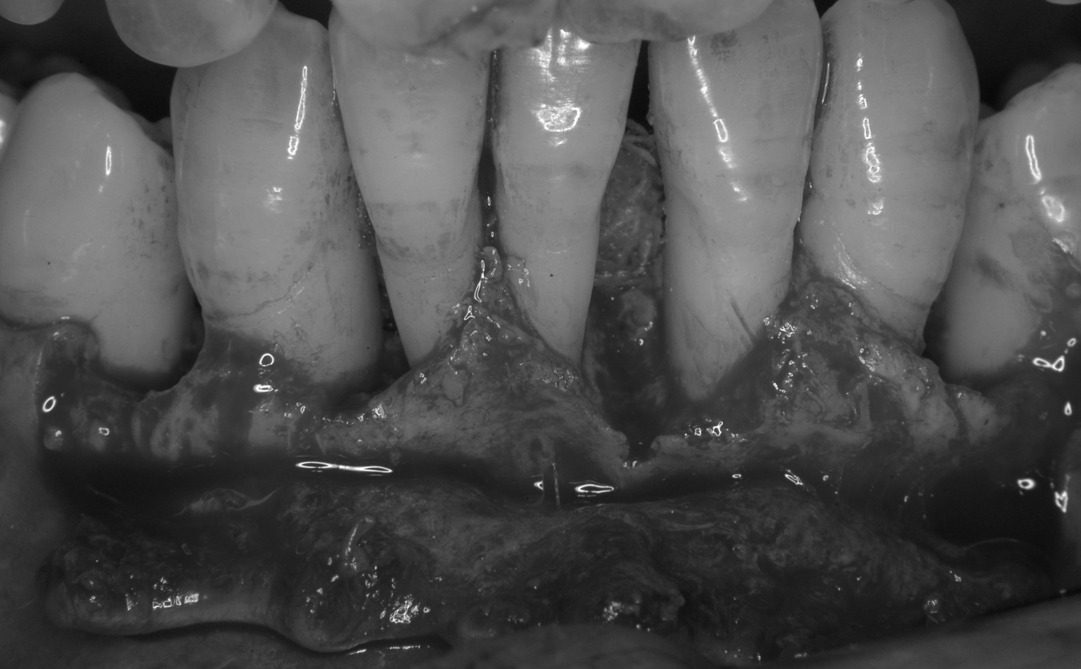 歯周組織再生誘導療法（下顎前歯部）