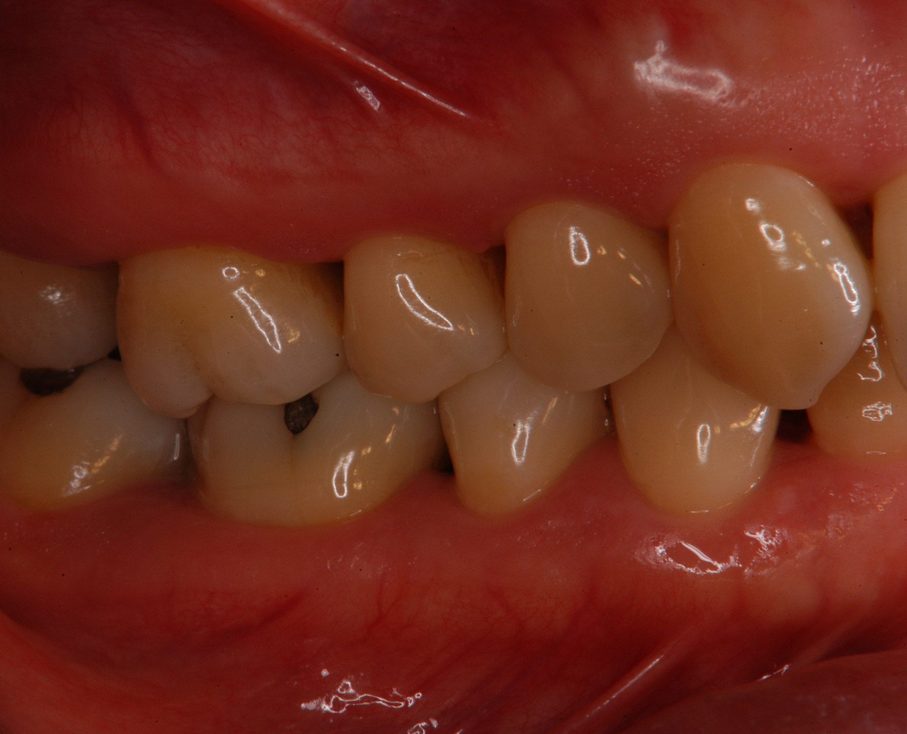 広汎型侵襲性歯周炎患者にエムドゲインゲルを用いた歯周組織再生誘導療法と矯正治療を行った症例