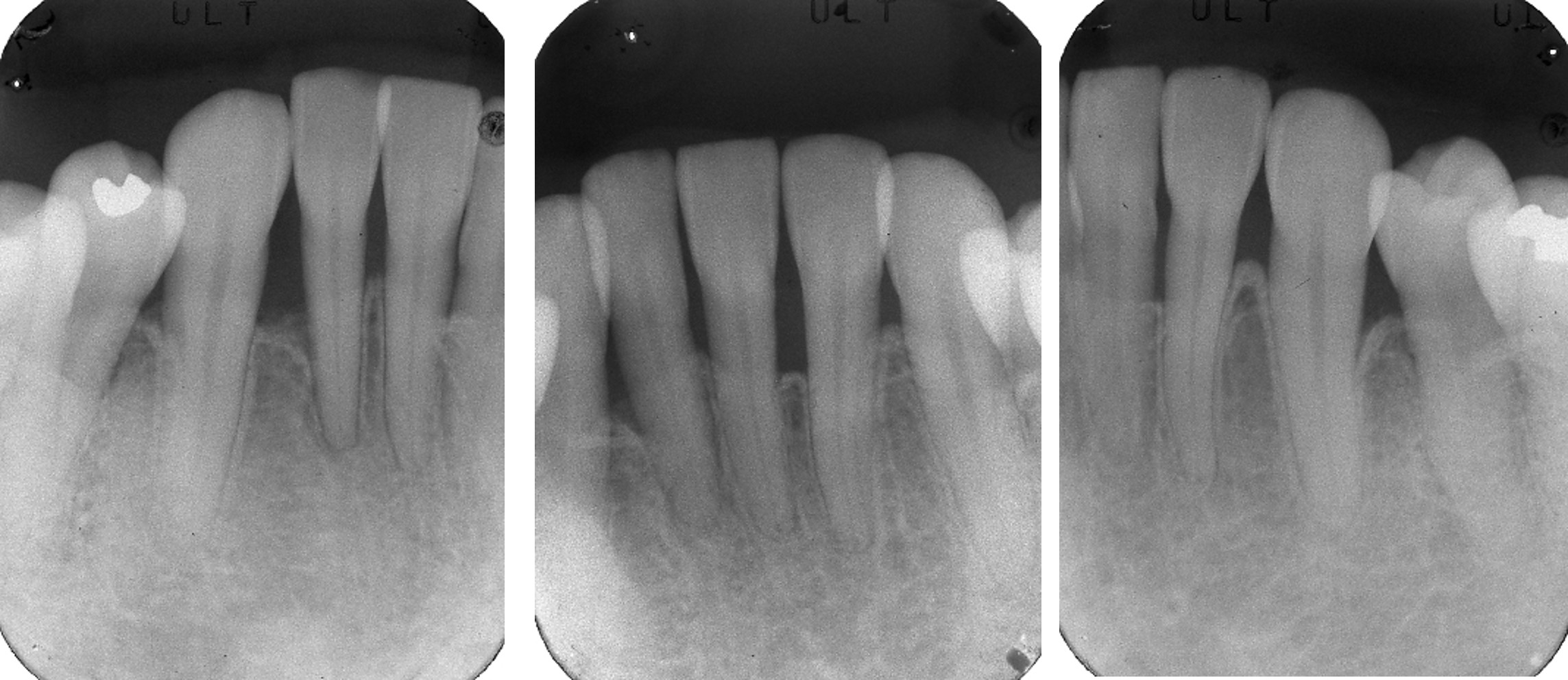 術前・術後のレントゲン写真（下顎前歯部）