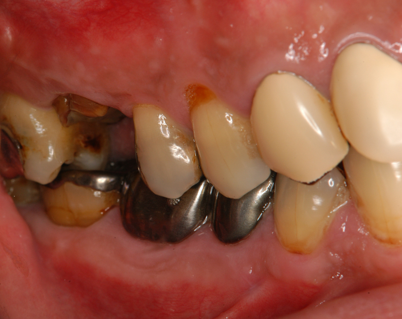 歯周炎患者の欠損補綴にインプラント治療を用いて包括的診療を行った一症例