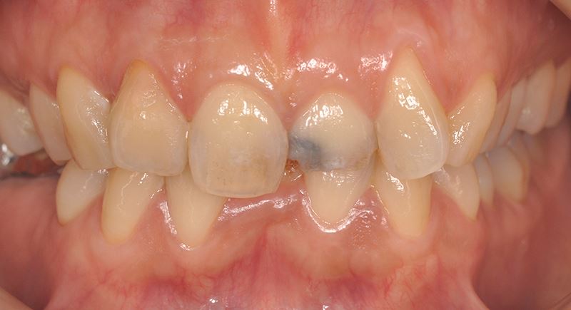 ジルコニアクラウンによる前歯部審美修復治療