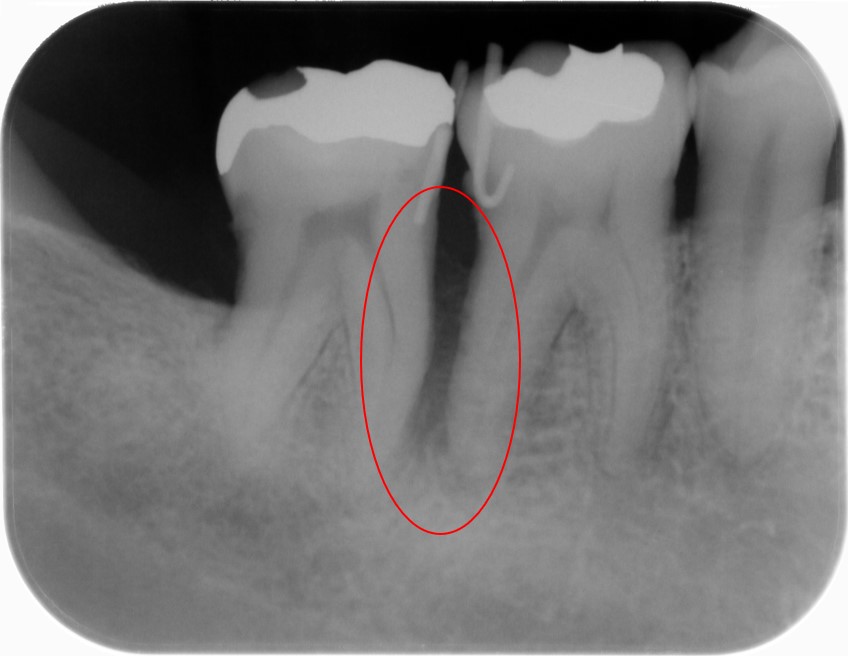 コンセプトを遵守したことにより著しい歯周組織の回復を認めたケース