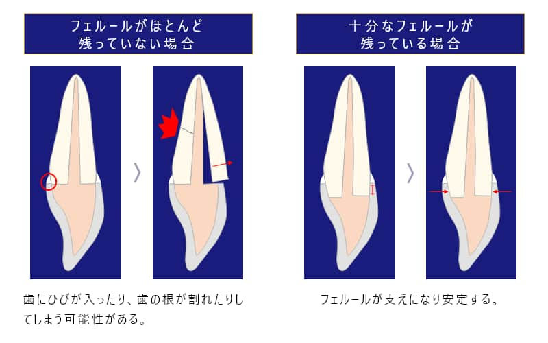 補綴治療した歯を永く保つために