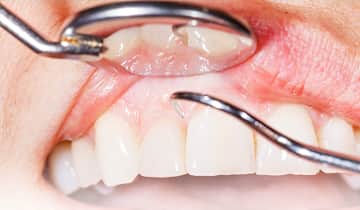 歯周病患者様に対する歯周外科治療